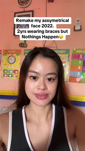 Bone Surgery for Asymmetrical Face Explained