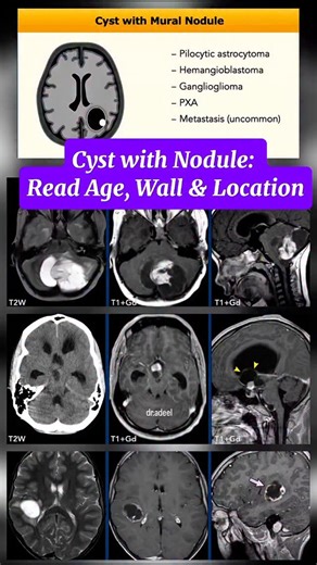 Adeel Ur Rehman on Instagram: "Cyst with Nodule 🧠 | Easy Radiology Diagnosis Trick Cyst with mural nodule is a classic brain imaging pattern. Age, location, cyst wall & nodule position make the diagnosis. 👶 Children → Pilocytic astrocytoma, ganglioglioma 🧑 Adults → Hemangioblastoma, metastasis 🧠 Key clues: pial surface, enhancing wall, cortical location Save & share if this helped you! #Radiology #Neuroradiology #BrainTumor #MedicalImaging #MRIbrain"