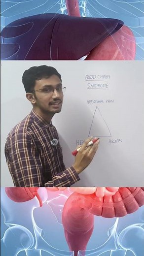 BUDD CHIARI SYNDROME: CLASSICAL TRIAD