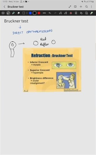 Bruckner test/ Red reflex test #squinteye #retinoblastoma #ophthalmology #refractiveerrors