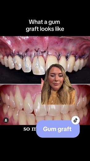 This is a big procedure and not a normal gum graft for just one tooth #gumrecession #gumgraft #onthisday