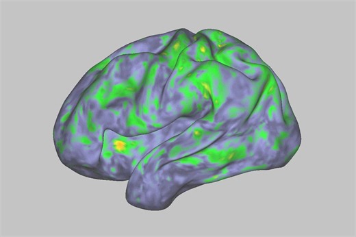 Ever wondered how psychedelics impact the brain? This image comes from dozens of brain scans produced by researchers at Washington University School of Medicine who gave psilocybin to participants in a study before sending them into a functional M.R.I. scanner. Dr. Siegel explains that the scrambled brain activity induced by these substances drives neuroplasticity, the brain’s ability to form new ways of thinking. Dr. Nico Dosenbach shares his surprise at the profound impact of psilocybin, stati