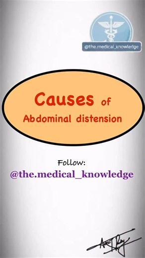 Medical Study on Instagram: "Abdominal distension is the abnormal increase in the size or girth of the abdomen due to accumulation of contents within the abdominal cavity. It is a clinical sign, not a disease, and indicates an underlying pathology. Mechanism Distension occurs when there is an increase in: • Gas → intestinal bloating • Fluid → ascites • Solid contents → feces, organs, or tumors • Fat or fetus Common causes (6 F’s) 1. Fat – obesity 2. Fluid – ascites (liver disease, heart failure,