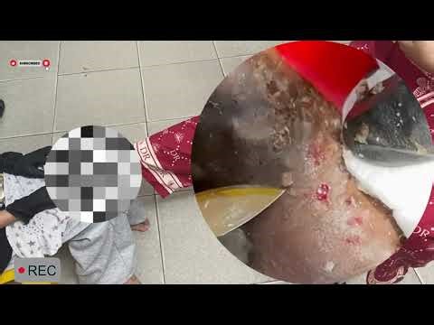 🔥 Severe Jigger Invasion – Hidden Layers of Damage Revealed! #CK145