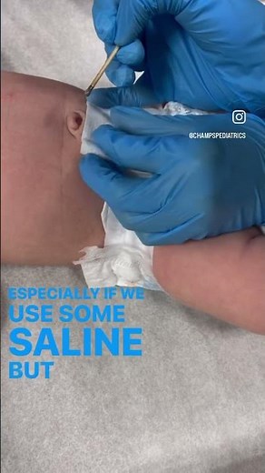 Cauterizing an umbilical cord with silver nitrate in the pediatric office