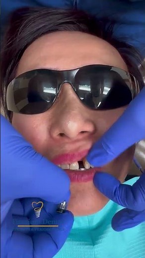 TITANIUM Dental - A Matching Front Tooth #dentist #dentalimplant #smile
