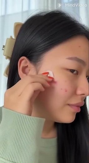 🤮 The WORST Cystic Acne Removal Compilation Ever GRAPHIC