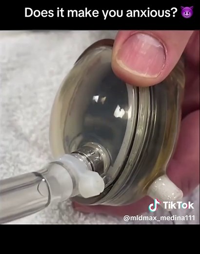 Would you get an artifical heart or a heart support pump implanted if it was the only way to keep living? How far would you go? What would you be willing to lose? This is the Berlin Heart LV Support Device. #nurses #doctor #nurse #fyp #fypシ #doctorsoftiktok #nursesoftiktok #cardiology