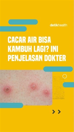 detikHealth on Instagram: "Pernah kena cacar air? Ternyata penyakit ini bisa “kambuh”, tapi dalam bentuk cacar api (herpes zoster). Hal ini terjadi karena virus varicella-zoster penyebab cacar bisa tetap “tidur” di saraf selama bertahun-tahun, lho detikers!⁣ ⁣ Simak penjelasan selengkapnya dari dr Ratni Indrawanti pada video berikut ini yuk detikers!⁣ ⁣ #detikHealth #CacarAir #Penyakit #Kulit #Cacar"
