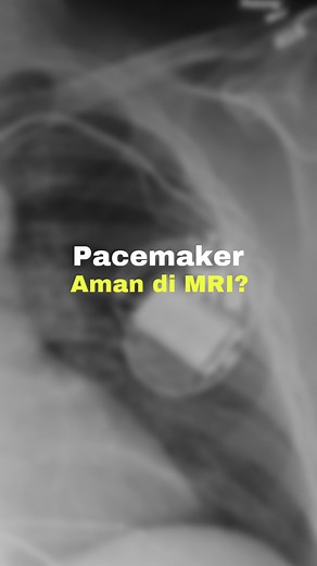 109K views · 155 reactions | kebanyakan orang dengan alat pacu...