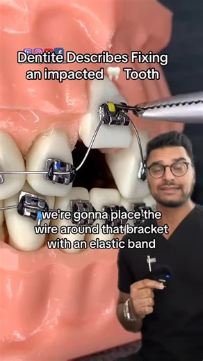 Dentite on Instagram: "Bringing an impacted tooth 🦷 down with braces 😬"