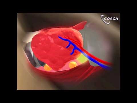 Minimally Invasive Total Thyroidectomy Video