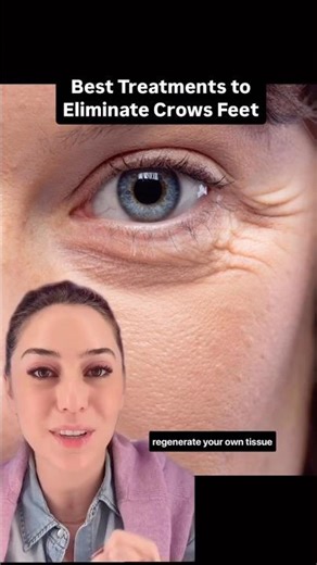 Best Treatments to Eliminate Crows Feet #shorts