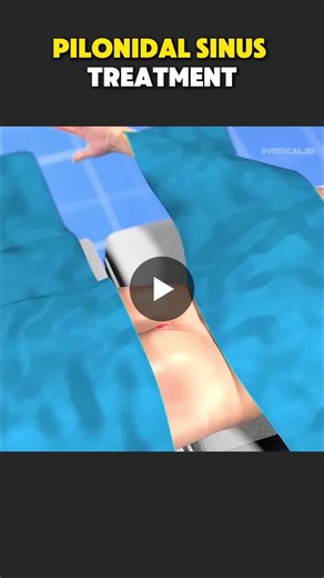 #pilonidal #sinus #generalsurgery #healthcare #medical #nurse #mohamedreda #linkedin | Mohamed Reda