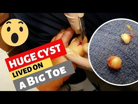 Dr. Kim removed epidermal cyst on a big toe. Patient can walk without pain now
