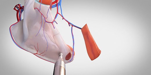 Scapula flap harvest - TVASurg - The Toronto Video Atlas of Surgery