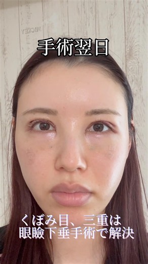 Day After Surgery/Ptosis: Hollow eyes and triple eyelids can be treated safely #lastcall #subbrow...