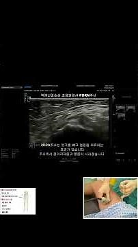 **제목: 엑스레이는 정상인데 무릎 안쪽이 계속 아프다면? '내전근관 증후군'과 수압박리술 치료법** #short #통증의학과 #pdrn주사 #강남연세신통의원