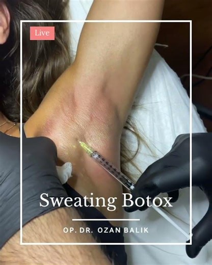 Sweating botox #sweatingbotox #botox