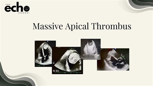 Massive Apical Thrombus: 2D Echocardiographic Findings, Classification, and TTE Acquisition Strategy