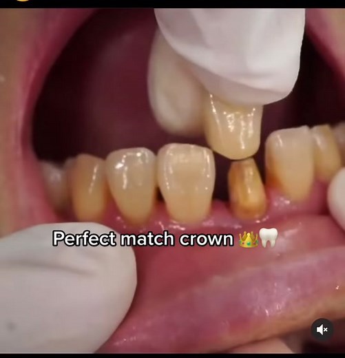 Front Tooth Crown: Enhancing Your Smile with Gold Crown for Front Teeth