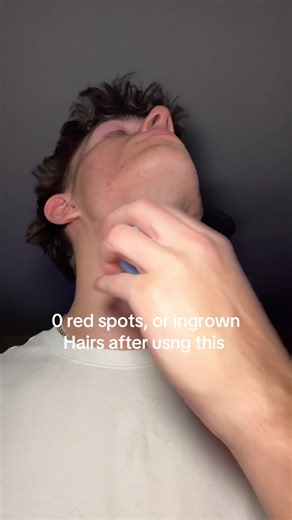 Effective Solutions for Preventing Razor Burn and Ingrown Hairs