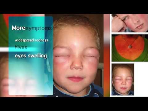 MCPS Anaphylaxis Training Video