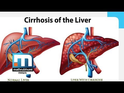Liver Sclerosis: Symptoms, complications and treatments | D@2PM | Mathrubhumi News