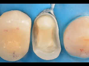 Cerec Overlay: Fully digital restoration at BAU Faculty of Dentistry