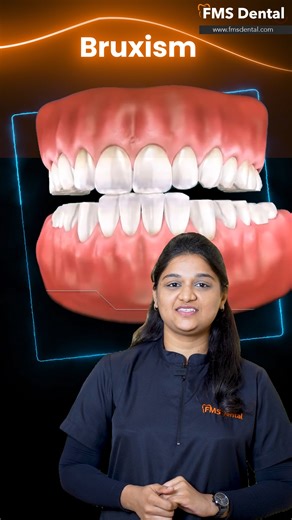 FMS Dental | Best Dental Clinics in Hyderabad on Instagram: "Do you wake up with jaw pain or headaches? 😬 You might be grinding your teeth during sleep. At FMS Dental, our custom night guards are designed to protect your smile and improve your sleep. ✨ Why a Night Guard? •⁠ ⁠Prevents teeth grinding (bruxism) •⁠ ⁠Protects enamel from wear & cracks •⁠ ⁠Reduces jaw pain, facial pain & headaches •⁠ ⁠Helps relax jaw muscles during sleep •⁠ ⁠Improves overall sleep quality 🦷 Why choose FMS Dental? •⁠