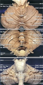 Cerebellar AVMs | Cohen Collection | Volumes | The Neurosurgical Atlas