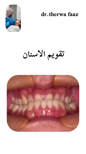 ‏تقويم الاسنان #صلوا_على_رسول_الله #متابعة_لايك_واكسبلور_احبكم