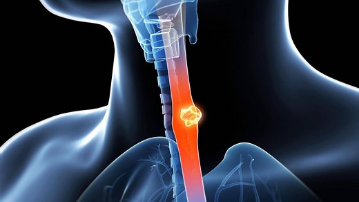 Speiseröhrenkrebs - was sind die ersten Symptome?