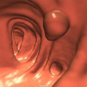 New Colorectal Cancer Screening Guidelines Are Here