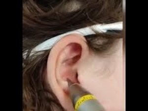 NADA Ohrakupunktur einfach erklärt Teil 2 - NADA Programm als LLLT mit HELBO Minilaser demonstriert