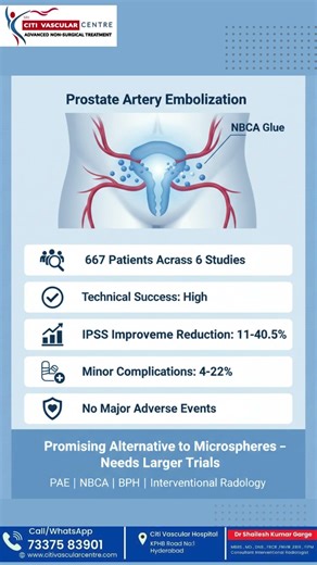 Prostate Artery Embolization with NBCA Glue at Citi vascular hospital