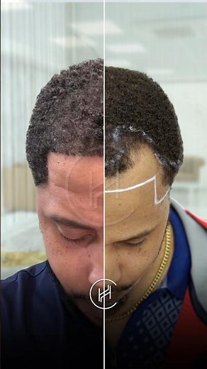 4500 Hair + 600 Beard Grafts Changed His Entire Look | Afro Hair Transplant Transformation