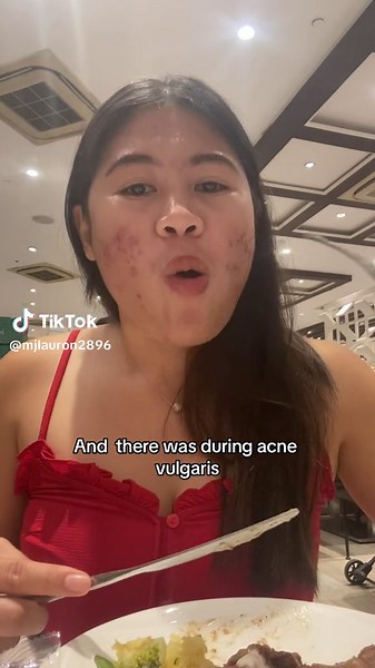 From Acne Vulgaris to Clear Skin: My Journey and Treatment