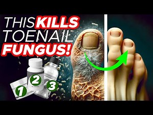 Top 3 Most Effective Treatments For ToeNail Fungus That Work Instantly