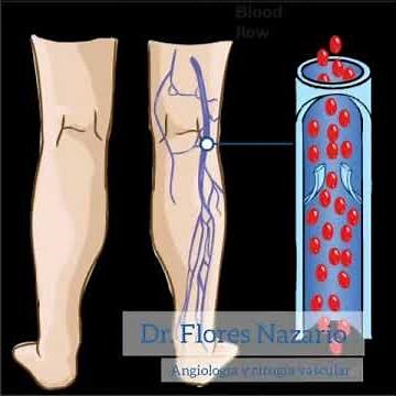 Doppler venoso válvulas venosas