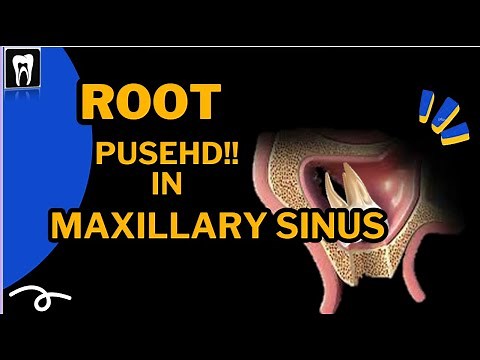 Root is inside the maxillary sinus | CBCT | Tooth extraction