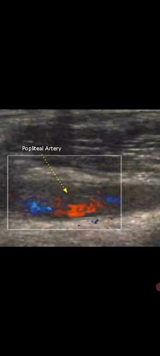 Popliteal Artery Entrapment Syndrome Ultrasonography#@Vascular Disease in lower limb#Awerenes of All