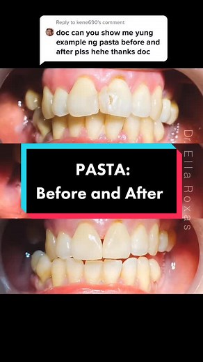 Pasta Teeth: Before and After Transformation