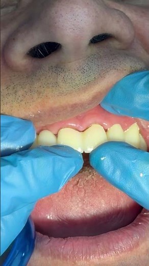 Zirconia Crown Cementation | Satisfying Dental ASMR (Silent)