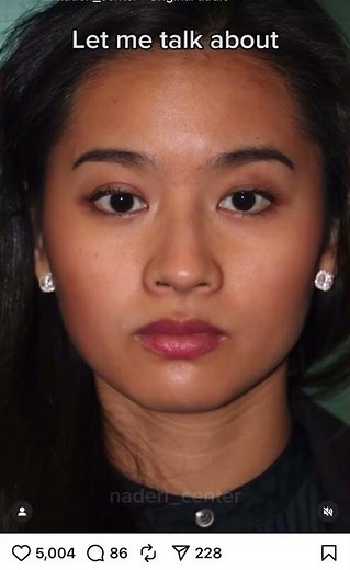 Harmonious transformation Asian Rhinoplasty results with Dr Naderi ✨ #rhinoplasty #naturalresults
