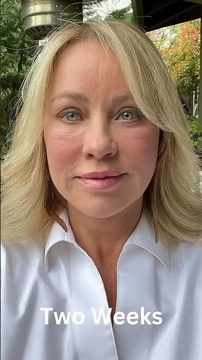 Day-by-day Facelift Recovery and Healing Process!