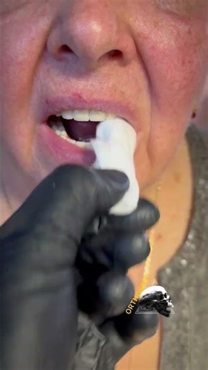 Full DENTURES 100% fixation. #dentalprosthesis #rehab #smile