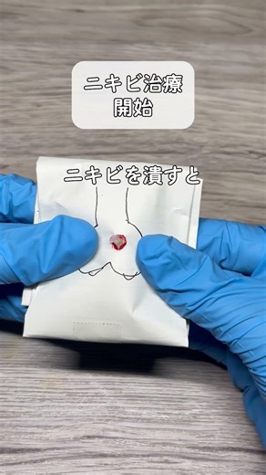 無限に潰したくなるニキビを潰しのASMR