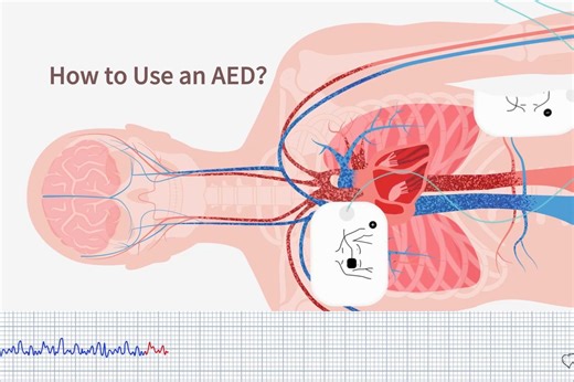 动画演示AED原理及使用方式How to Use an AED