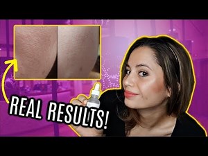 The Ordinary Niacinamide Before and After | 2 MONTH RESULTS!